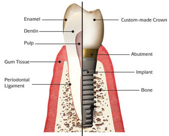 Dental Implants