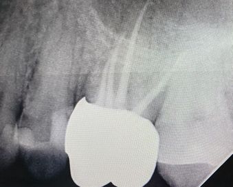 Root Canals